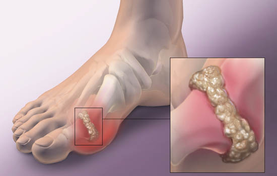 RƯỢU, BIA LÀM TĂNG NGUY CƠ BỆNH GOUT