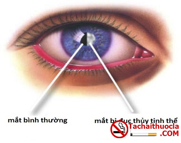 HÚT THUỐC LÁ GÂY NÊN CÁC BỆNH VỀ MẮT