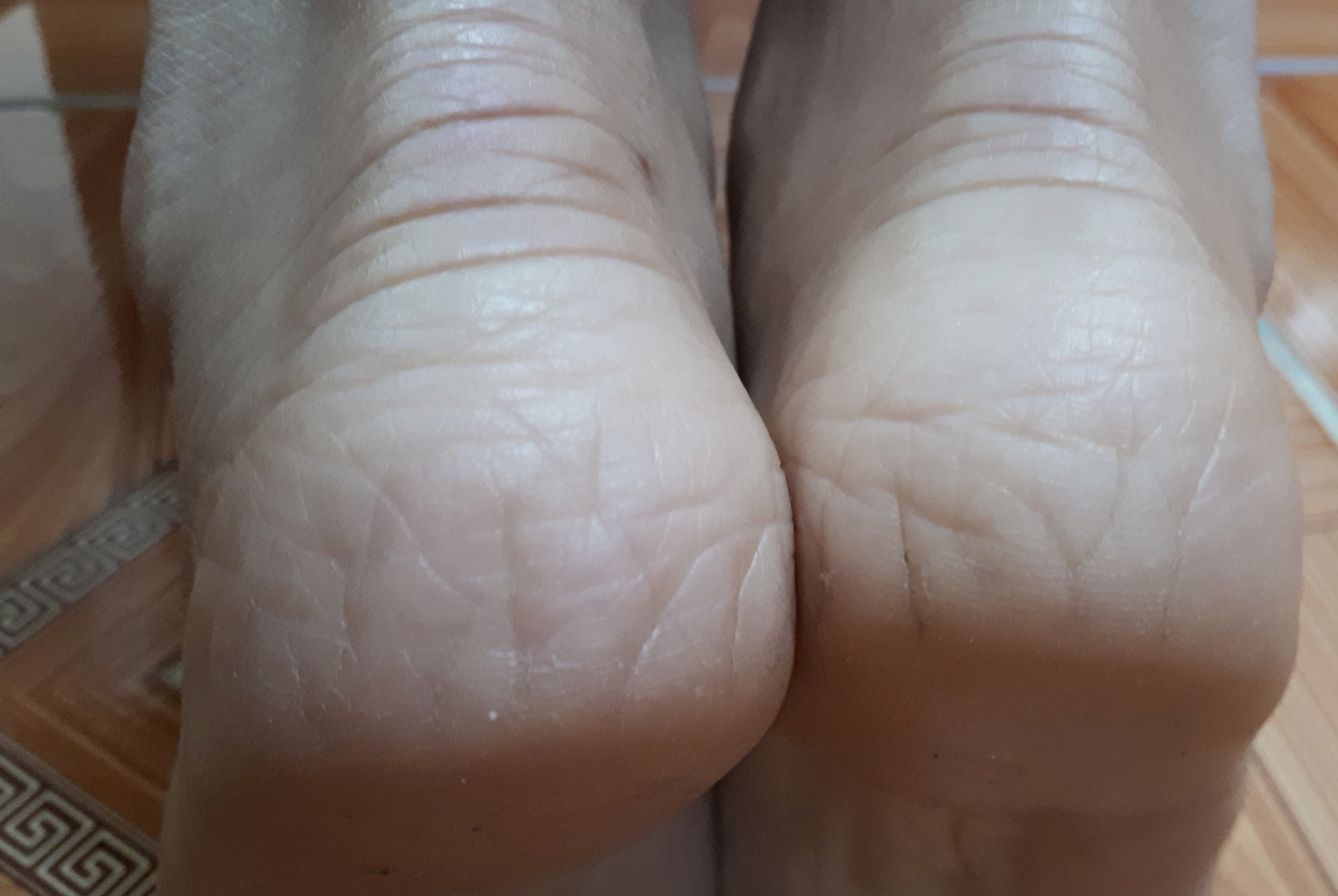 Trị da nứt nẻ mùa hanh khô
