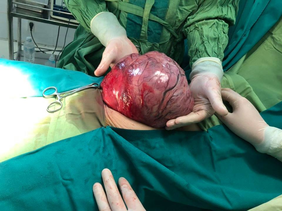 Khối u được phẫu thuật lấy ra từ ổ bụng bệnh nhân Ly Gìa D.