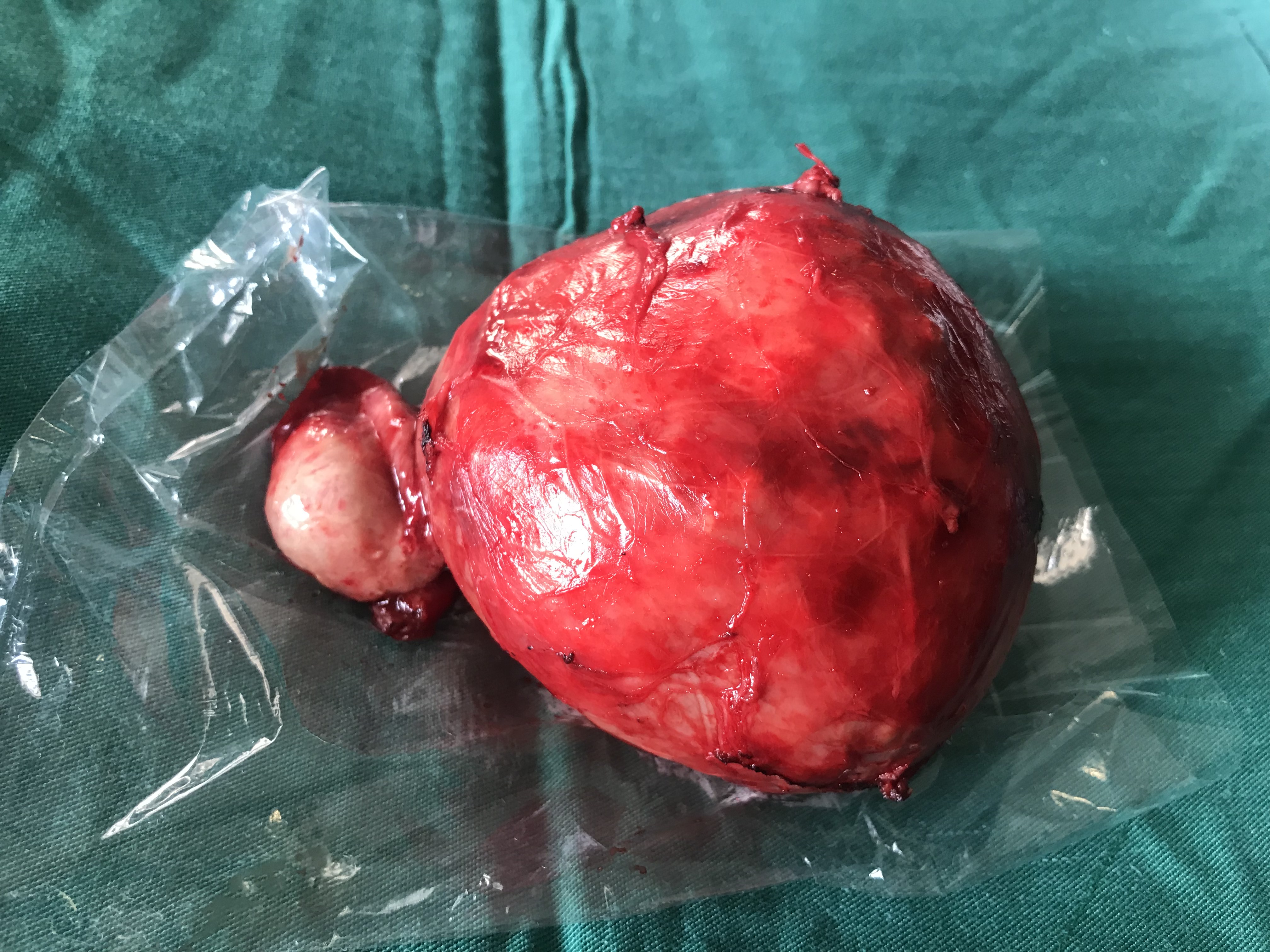Khối u của người bệnh Tráng Văn L. đã được cắt bỏ