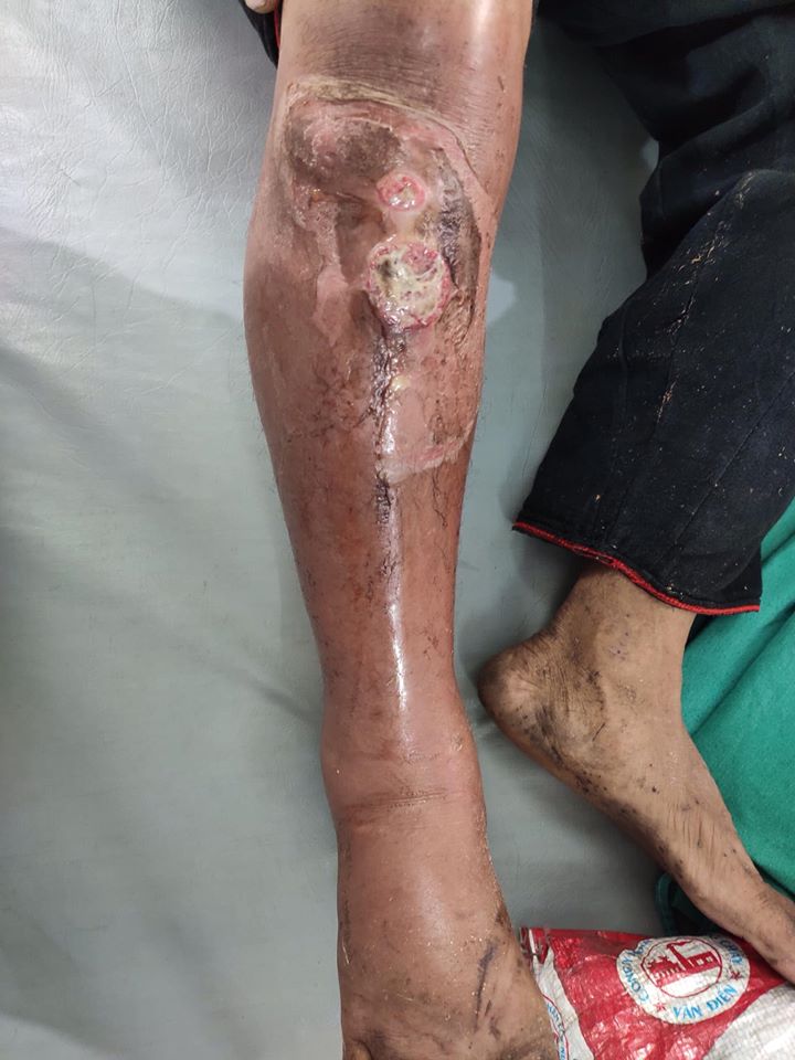 Vết thương bị nhiễm trùng do người bệnh tự ý lấy lá thuốc nam để bó