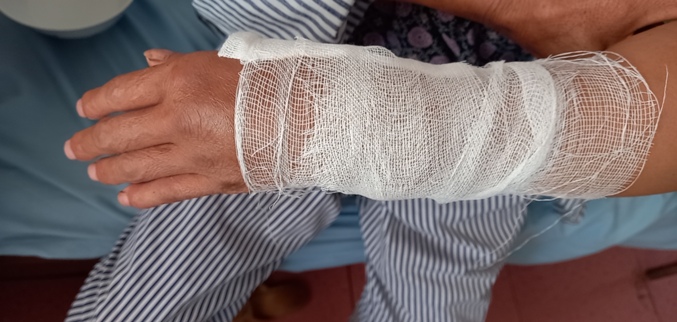 Mối nguy can lệch, cứng khớp sau gẫy xương do bó thuốc nam tại nhà