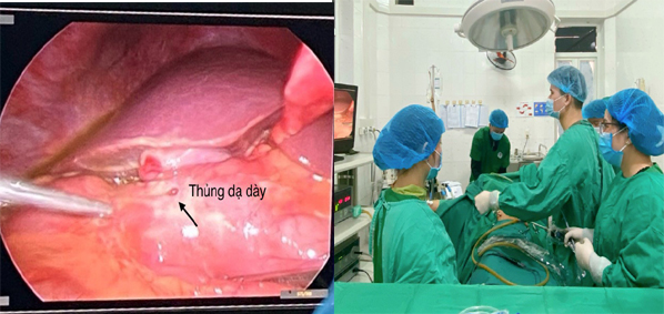Bệnh viện ĐKKV Bắc Quang phẫu thuật cấp cứu cho bệnh nhân thủng dạ dày