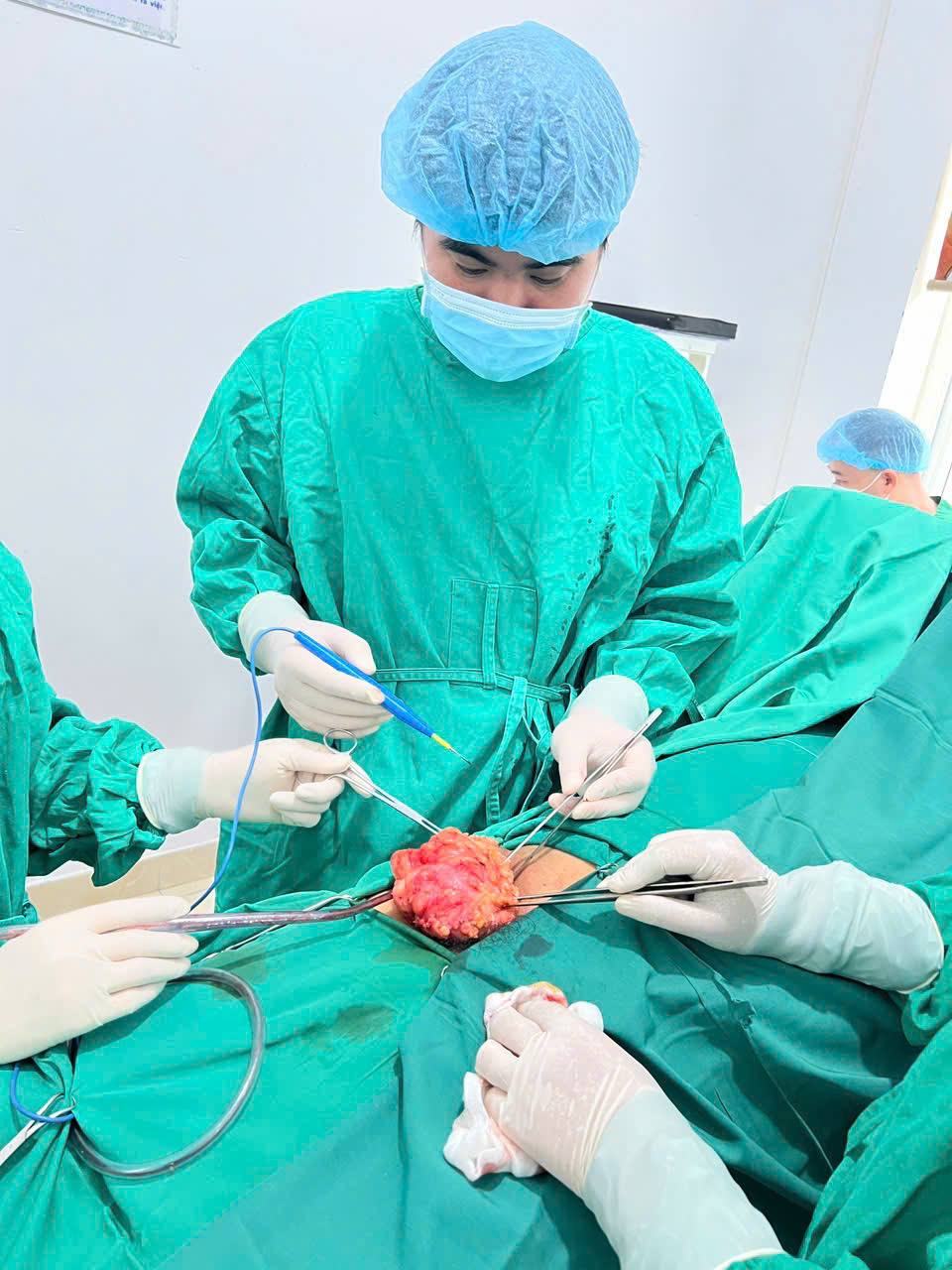 Phẫu thuật bóc tách thành công khối u mỡ cho bệnh nhân 61 tuổi