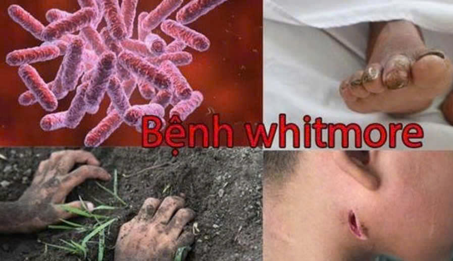 Bộ Y tế khuyến cáo phòng bệnh Whitmore