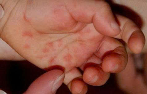 Tuyên Quang tăng cường các biện pháp phòng, chống bệnh Tay - Chân - Miệng