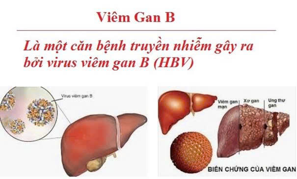 Mỗi người cần chủ động phòng chống viêm gan vi rút và ngăn ngừa ung thư gan (Ảnh nguồn Internet).
