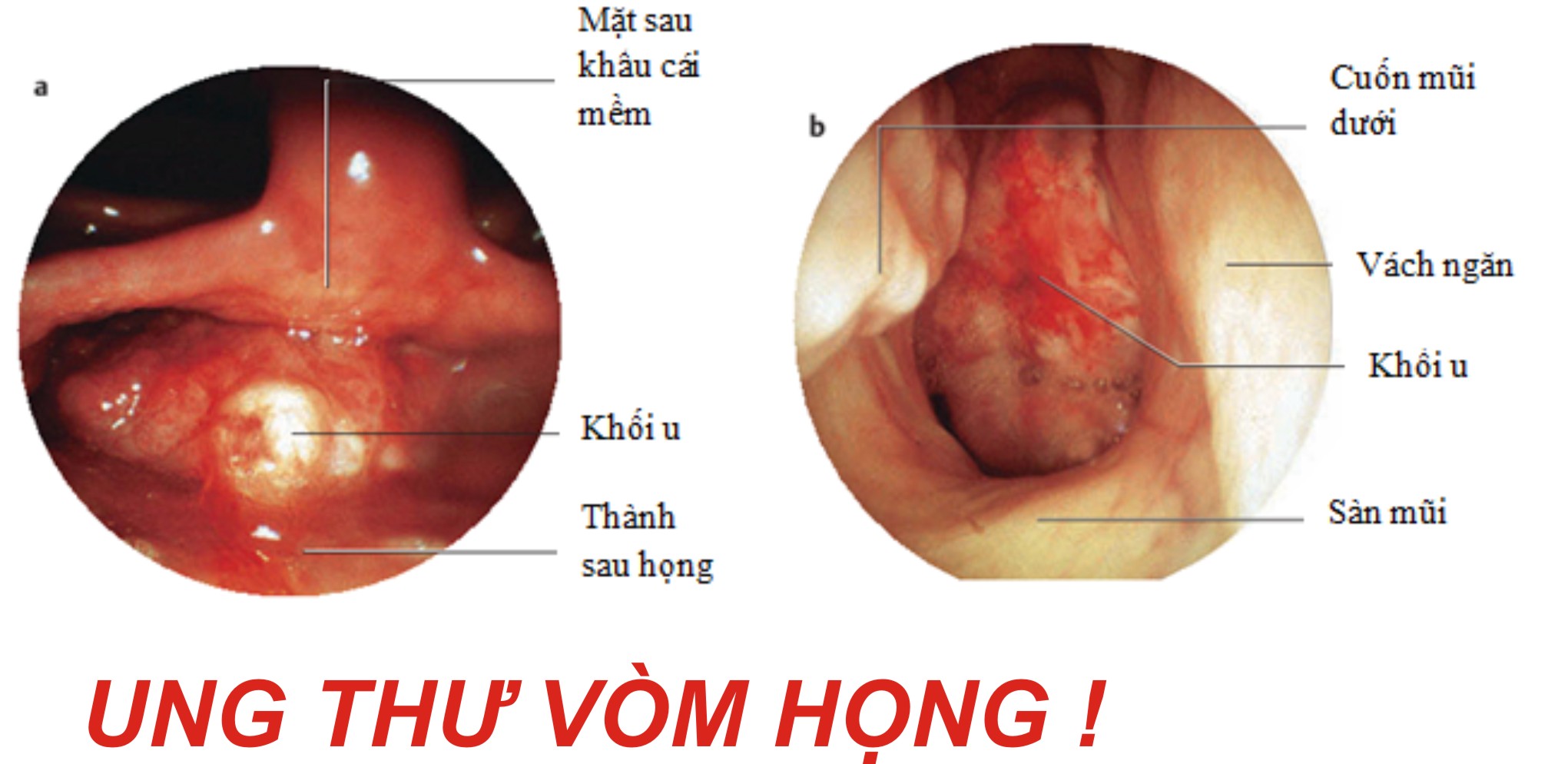 HÚT THUỐC LÁ VÀ MỐI LIÊN QUAN VỚI BỆNH  UNG THƯ VÒM HỌNG